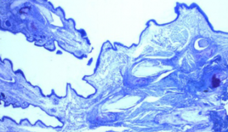 Close up of Tuberculosis