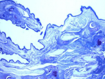 Close up of Tuberculosis
